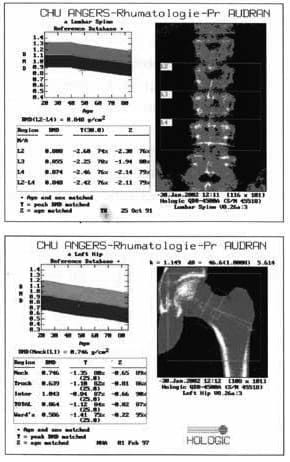 Result of bone densitometry measuring bone mineral density