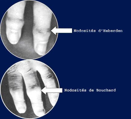 Nodosité et arthrose des doigts