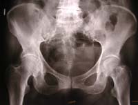 Coxo femoral, imagen estándar