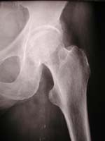 Coxo femoral, imagen estándar
