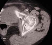 Coxo femoral, TDM