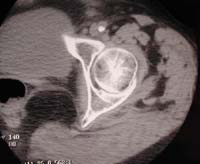 Coxo femoral, TDM