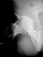 En el perfil de cadera, osteofito del borde del cotilo indiscutible indicando la coxartrosis.