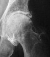 Coxartrosis interna con pinzamiento estadio III, osteofitosis pericapital y del cotilo, geodas de la cabeza y condensación de su polo superior