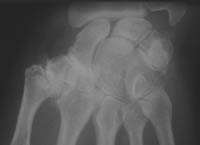 Ampliación de la muñeca que muestra la rizartrosis (flecha) y la artrosis escafotrapezoidal (cabeza de la flecha) con condensación subcondral.