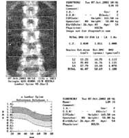 Densitometría del raquis lumbar Aparato Hologic