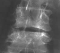 Lateroflexión izquierda del mismo paciente que desvela un fenómeno de vacío discal y permite descartar una espondilodiscitis (flechas). Lateroflexión izquierda del mismo paciente que desvela un fenómeno de vacío discal y permite descartar una espondilodiscitis (flechas).