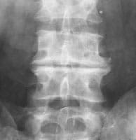 Discoartrosis L4-L5 - hundimiento discal muy pronunciado, condensación de las plataformas y osteofitosis lateral