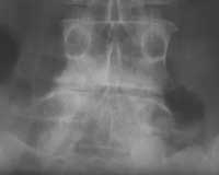 Discoartrosis L4-L5 con inestabilidad intervertebral. Pinzamiento discal marcado en la imagen de frente.