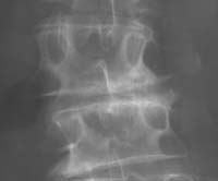Discoartrosis con subluxación lateral (laterolistesis) (flechas), pinzamiento lateralizado a la izquierda y escoliosis artrósica.