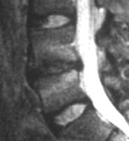 Discreta hiperseñal arquiforme en espejo de tipo edematoso a distancia de las plataformas vertebrales (flechas).