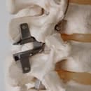 Un nouvel implant pour traiter les fractures vertébrales