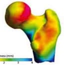 Ostéoporose: l'ostéodensitomètre en 3 D