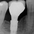 Ostéoporose et implants dentaires