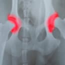 diagnostic arthrose de hanche et radiiographie