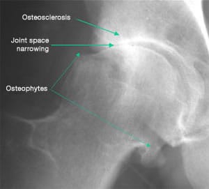 Osteosclerosis is condensation of the subchondral bone.