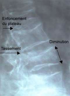 Aspects of osteoporotic vertebral fractures on spine