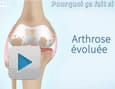 Comprendre l’arthrose du genou