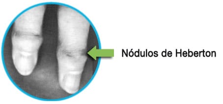 osteoartritis Heberden nudosidades