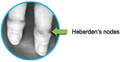 osteoarthritis heberden's nodes