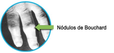 osteoartritis Bouchard nudosidades