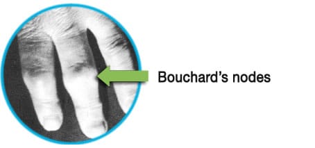 osteoarthritis bouchard's nodes