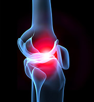 Quelles sont les causes de l'arthrose ? - Arthrolink