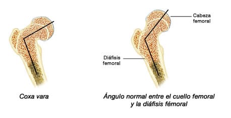 osteoartritis coxa-vara