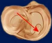 osteoarthritis-meniscectomy