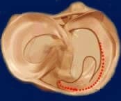 osteoarthritis-meniscectomy