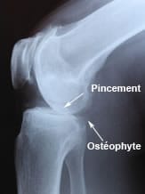 pincement et ostéophyte