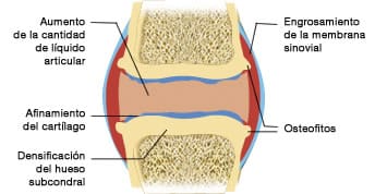 Una articulación con osteoartritis