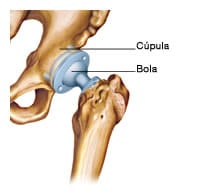 prótesis de la cadera