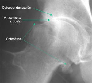 oteoartritis radiografía