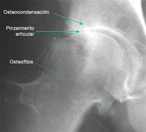 Fig 6 : Una osteocondensación es una condensación del hueso subcondral.