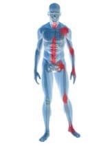 osteoarthritis és osteoarthritis