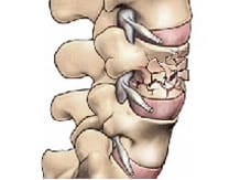 osteoporose fracture vertébrale