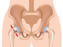 osteoporose fracture du col du fémur