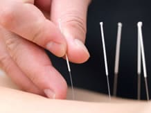alternative medicine acupuncture