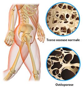 osteoporose différence os malade