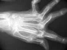 Rheumatoid arthritis hand radiography