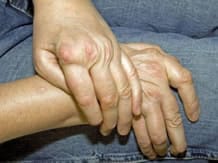 Rheumatoid arthritis hands