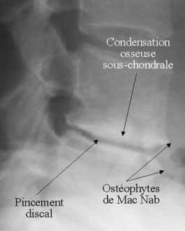 Radio d'exemple d'ostéocondensation