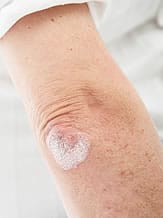 Psoriatic arthritis psoriasis