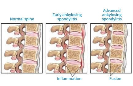 Ankylosing spondylitis spine