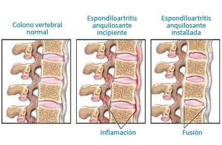 espondiloartritis anquilosante style=