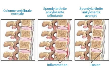 Spondylarthrite ankylosante symptômes : Inflammation colonne ...