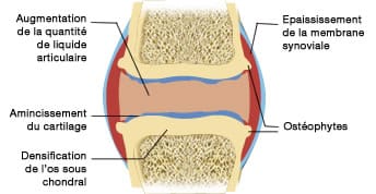 articulation arthrosique