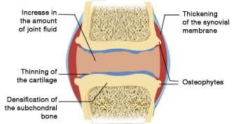 an osteoarthritic joint