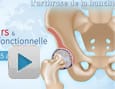 Comprendre l’arthrose de la hanche